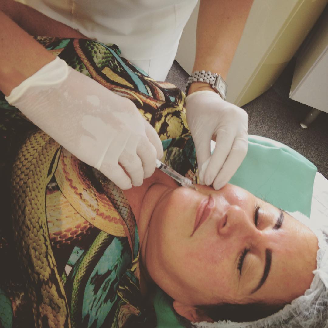 Botox – preenchimento facial com ácido hialurônico. Dra Rosa #evestetica #botox #semrugas #esteticasbc