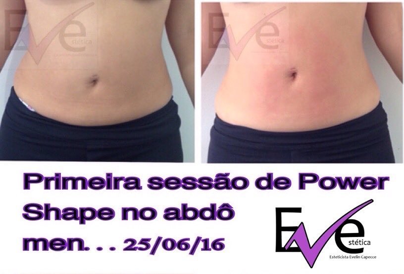 Esse resultado é de uma primeira sessão… Vamos postar até a sexta sessão que é o recomendado nesse caso.
#PowerShapeénaeveestetica 
#divascomPowerShapeSBC 
#eveesteticasaobernardodocampo