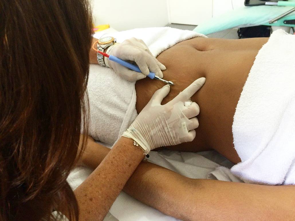 O Striat é um tratamento que objetiva a regeneração da pele afetada pelas estrias através de eletroestimulação. Esse processo inflama a pele onde se encontra a estria que ao se regenerar, produz colágeno e diminui a extensão da estria tornando-a menos visível.

Entre em contato e agende uma avaliação! ​Evestetica | Estética em São Bernardo – Evestetica​

#Evestetica #tratamento #estetica #beleza #rejuvenescimento #melasma #cicatrizes #colageno #mulher #autoestima #aparência #estrias #cicatrizes #saudavel #pelebonita #botox #saude #bonitaparaoverao #emagrecer #fitness #dieta #esteticaemsaobernardodocampo #belezanatural #secuidar #celulite #flacidezcorporal #projetoverao #diva