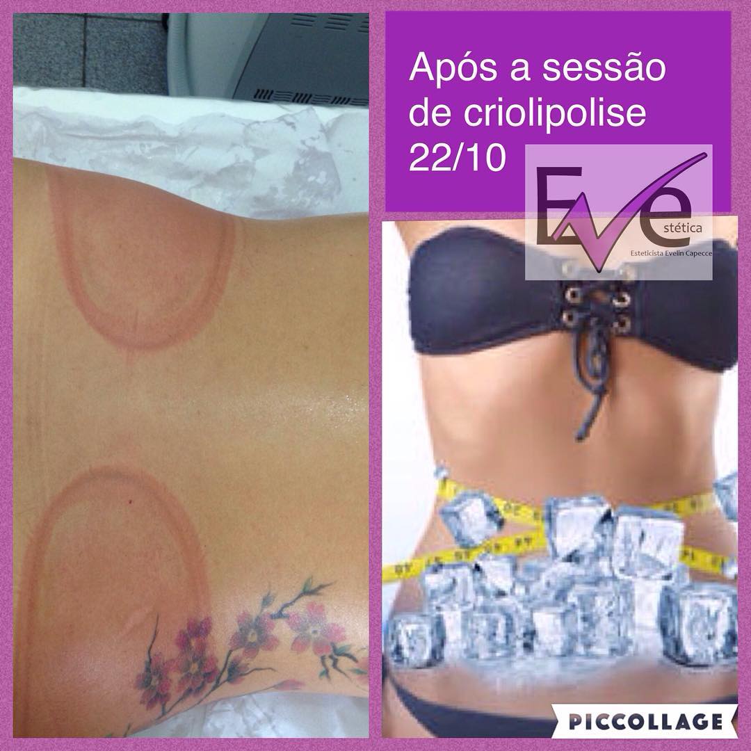 A partir do décimo dia a quebra de gordura já pode ser visível, mas o efeito máximo acontece de dois a três meses após a sessão. “É possível medir a diferença na fita métrica, mas a melhor maneira de fazer a comparação de fotografias de antes e depois, na mesma posição”, Em uma única sessão, estudos científicos apontam redução de 20% a 25% da gordura localizada na região tratada. Mas claro, os resultados variam de pessoa para pessoa…importantes fazer o tratamento pós crio…
#gelo#congelarasgordurinhas #verao2017 #praiacombiquini #esteticaeve #estéticaabc ##cliente#criolipoliseéaquinaeveestetica#top☺︎