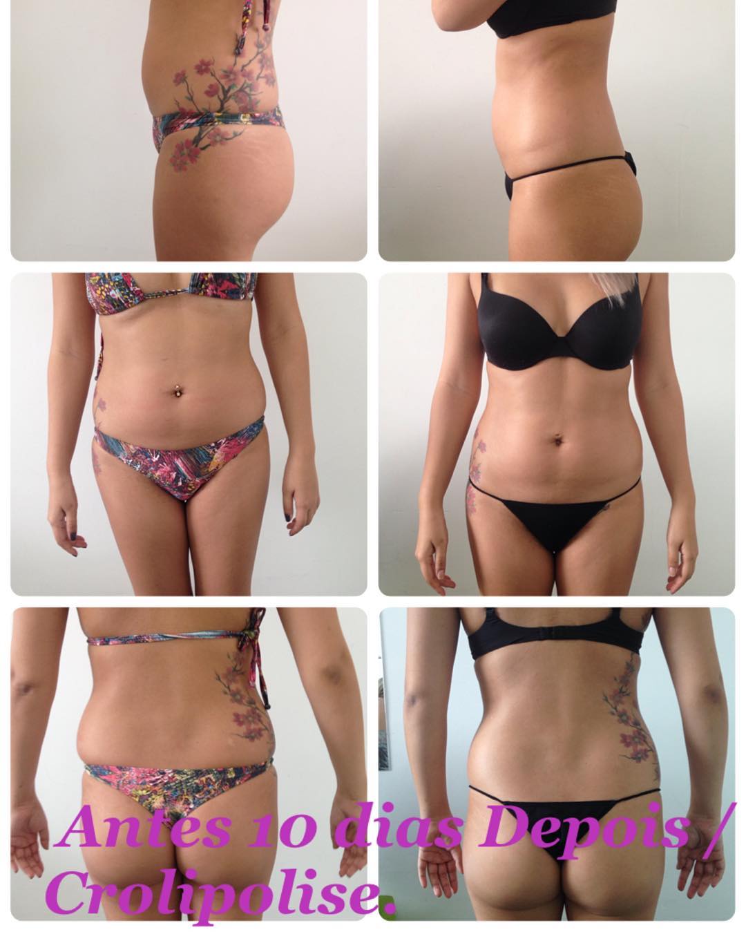 Hoje vou colocar alguns resultados da Criolipolise…
Em uns 15 dias após a sessão já é possível verificar alguma perda de gordura, mas o resultado máximo só se consegue de 2 a 3 meses após a aplicação. Cada pessoa tem um tipo de resposta, e também de velocidade dessa resposta. Também há uma necessidade pra cada corpo: algumas pessoas necessitam de apenas uma sessão, outras podem precisar de duas ou três pra determinada área. Isso quem vai dizer é o profissional responsável, no momento da avaliação. Mas, de forma geral, em uma única sessão já se nota um resultado fantástico!

#cliente#criolipolise #resultado #evestetica #esteticanoabc #verao2017 #esteticacomamor #