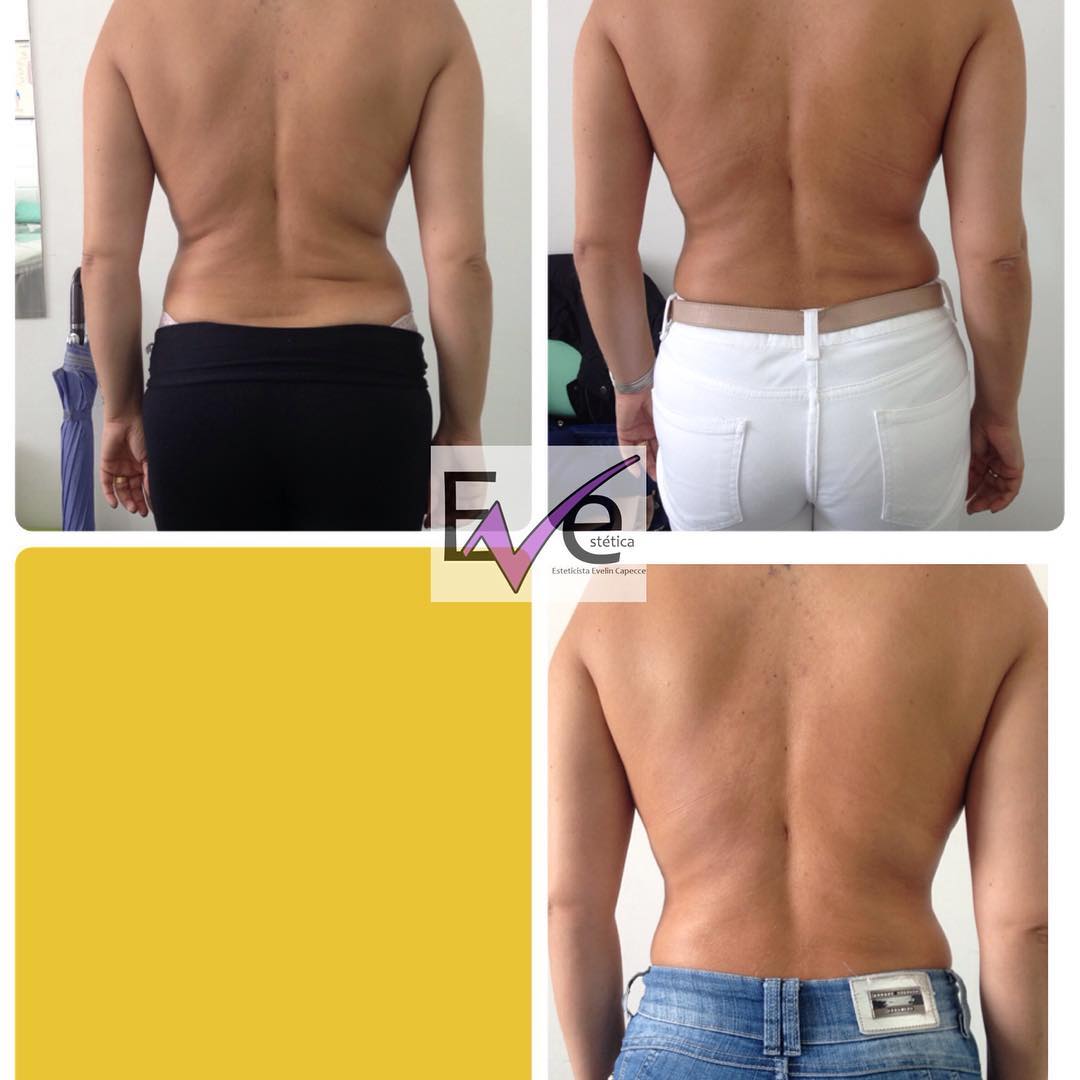 Resultado da Criolipolise feita nas dobras das costa… 15 dias pós Criolipolise…
#evestetica #criolipolise #esteticacomamor #esteticanoabc #verao2017 #cliente #clientesatisfeita #top#