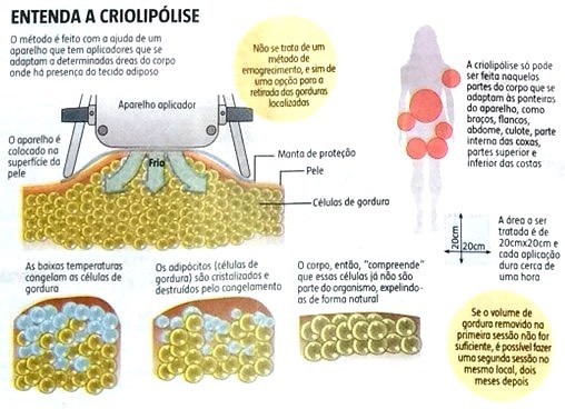 Bem simples para entender a Criolipolise..