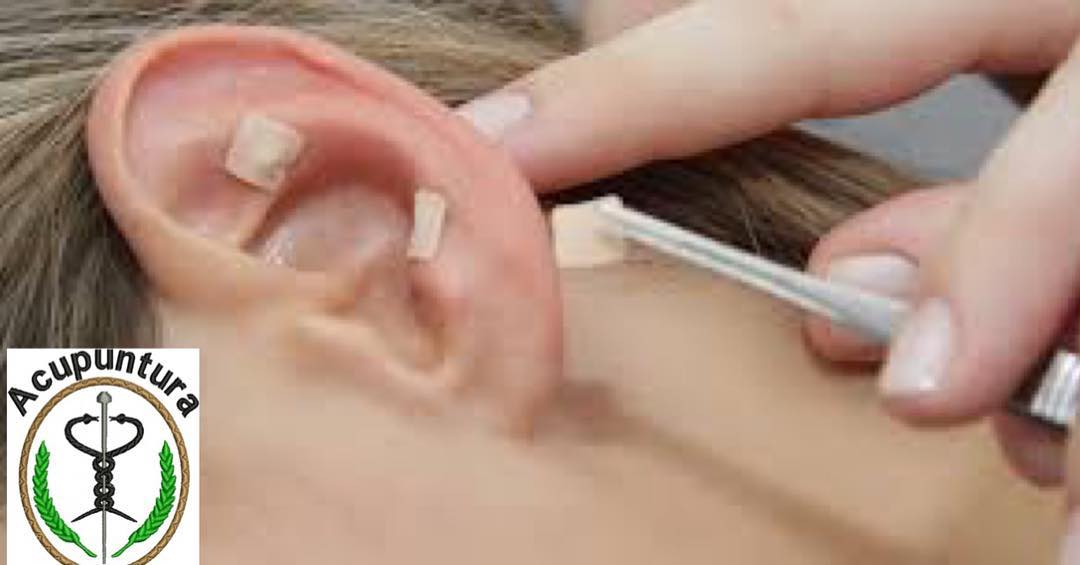 Agora temos mais uma parceria com a Dra Marli Breda Pellegrim, fera em acupuntura. Segue texto sobre como a acupuntura ajuda no emagrecimento!!! Auriculoterapia e emagrecimento 
A auriculoterapia é uma forma de tratamento através de estímulos em determinados pontos na orelha.
Estes pontos na orelha correspondem aos nossos órgãos e podem ser estimulados, fazendo com que o cérebro receba impulsos que resultam em fenômenos físicos relacionados ao órgão ao qual o ponto estimulado corresponde.
Uma das maiores vantagens da auriculoterapia é que ela é de ação rápida. Ela pode, por exemplo, melhorar dores de cabeça rapidamente em uma sessão. 
Para as pessoas que estão querendo perder aqueles quilos extras que ganharam nas festas e não querem recorrer a dietas milagrosas a auriculo vai ajudar!
Ela oferece também vários benefícios trata enxaquecas e insônia !!
E a auriculoterapia para emagrecimento, como funciona?
Antes de qualquer coisa, vale lembrar que apenas a auriculoterapia não irá te fazer emagrecer se você não tiver uma alimentação balanceada e não fizer exercícios físicos!  Sempre que a ansiedade ataca, a vontade de comer um doce ou alimento gorduroso ataca junto, e isso pode prejudicar muito o plano de perder peso.
Mas não é só isso. Se você tem dificuldade de perder peso devido a algum problema, como diabetes tipo II ou problemas digestivos e intestinais, basta que o estímulo da auriculoterapia seja direcionado a esses órgãos e você poderá ver uma melhora nesses aspectos e, consequentemente, no seu emagrecimento.

Como é feita e quantas sessões são necessárias?
Uma sessão de auriculoterapia começa com uma avaliacao na qual o profissional identifica suas necessidades e as áreas que deverão ser estimuladas. Após essa avaliação inicial, o profissional faz uma avaliação visual, para confirmar de que forma ocorrerá o atendimento.
Depois disso, o profissional pode usar microagulhas, parecidas com as da acupuntura, ou mesmo pequenas sementes, que são fixadas nos pontos da orelha através de um esparadrapo, para estimular os pontos da orelha. No caso do uso das sementes, elas permanecem na orelha do paciente por três dias..,
Agende sua avaliação grátis..
