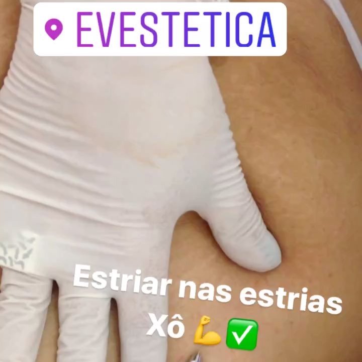 O Striat é um tratamento que objetiva a regeneração da pele afetada pelas estrias através de eletroestimulação. Esse processo inflama a pele onde se encontra a estria que ao se regenerar, produz colágeno e diminui a extensão da estria tornando-a menos visível.

Entre em contato e agende uma avaliação!