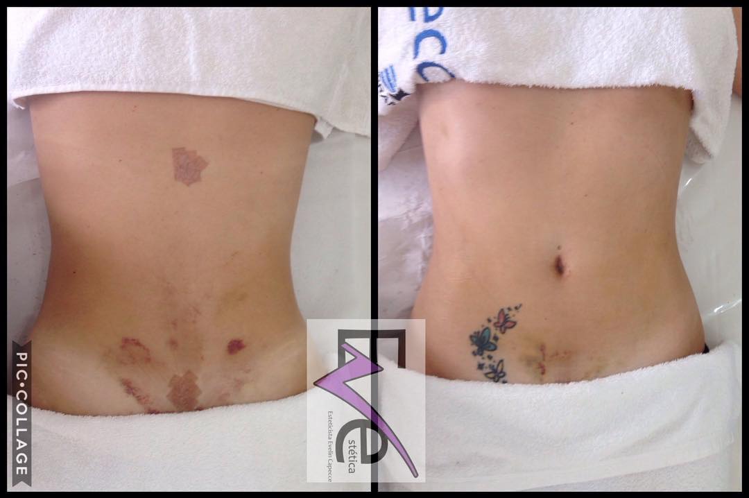 A importância da drenagem linfática no pós-operatório! 
A drenagem linfática no pós-operatório representa até 30% no resultado de determinadas cirurgias plásticas. Graças aos movimentos circulares e a pressão usada neste tipo de massagem, é possível: melhorar o fluxo sanguíneo, diminuir a retenção de líquidos, aliviar as dores, acelerar a cicatrização, nutrir as células, reduzir fibroses e eliminar marcas e hematomas.
#lipoescultura #cirurgiaplastica #drenagemlinfatica #clientesfelices #esteticaeve
