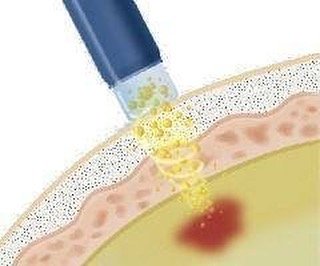 A fonoforese consiste em uma técnica realizada com o ultra som, aumentando a permeabilidade das membranas e otimizando a penetração de ativos eficazes no combate à celulite e gordura localizada. Geralmente são utilizados produtos com ativos lipolíticos e potente ação anti celulite à base de cafeína, centella asiática, hera, l-carnitina, dentre outros. Agende avaliação….35340031
#foco #esteticasaobernardo #semcelulite #corpoperfeitotequero #esteticafacial #corporal #belcorpo #beautifulbody