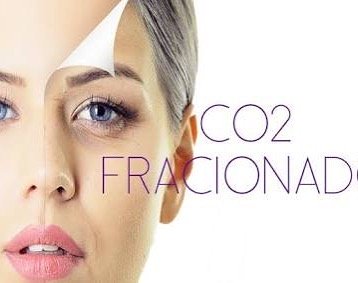 Chegou à época dele … o meu preferido laser.💗 O laser CO2 fracionado é indicado para pessoas que buscam rejuvenescimento da pele, remoção de cicatrizes em geral (como de acne) e estrias, ou o fim da flacidez. Ele é excelente para rugas, pois consegue atingir diversas superfícies da pele, nivelando sua estrutura. Além disso, como o laser CO2 total, ele estimula a produção de colágeno nas áreas em que agride a pele, dando a elas uma aparência mais jovem.

Agende já o seu horário 3534 0031 – Rua Marmará, 226 Jd do Mar – SBC
#co2fracionado 
#semmanchas #flacidezdepele 
#estriasbrancas #semrugas #pelelinda #renovarapele #ficarbellissima#evestetica #beautiful#beauty#qualidade #bemestar #job#autoestima #evestetica #vemficarmaislinda #clínicasãobernardodocampo#abcestetica