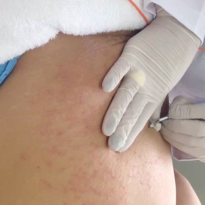 O Striat é um tratamento que objetiva a regeneração da pele afetada pelas estrias através de eletroestimulação. Esse processo inflama a pele onde se encontra a estria que ao se regenerar, produz colágeno e diminui a extensão da estria tornando-a menos visível.💃🏻 Entre em contato e agende uma avaliação!….