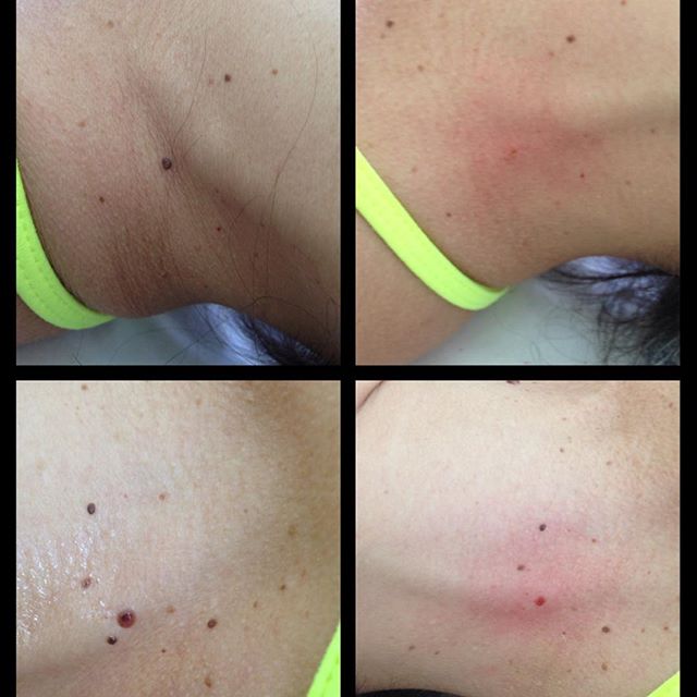 Estamos cada vez mais encantada com os resultados do Jato de plasma. Olha esse resultado de remoção de pintas (sinais) em uma única sessão.😀 #jatodeplasma #eveesteticatem