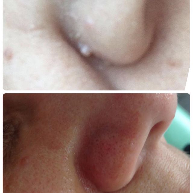 Após limpeza de pele retirada de uma verruga e milium com Jato de Plasma. 😍

#clientesatisfeita #jatodeplasma #pele #eveesteticasaobernardodocampo #evesteticatem